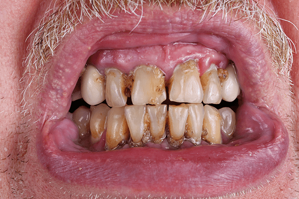 Rotten teeth. oil pulling therapy.