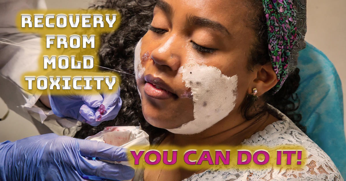 Recovery From Mold Toxicity: How to Start the Healing, an article cover image of a woman being treated for mold toxicity A naturalmaxhealth.com blog post.
